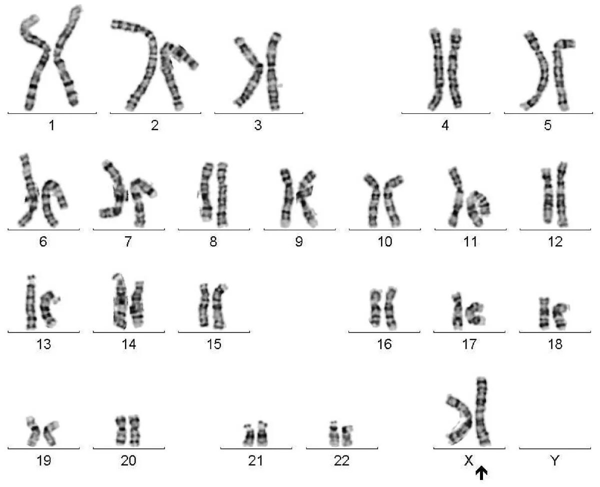 Хромосомы краба. 12 Хромосома. Двенадцатая хромосома человека. Идиограмма хромосомы 1. 12 Хромосома мутация.