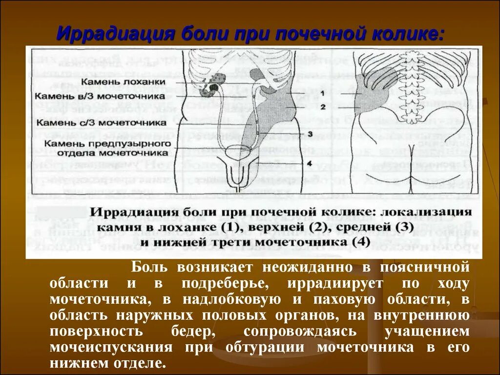 Почечная колика локализация. При почечной колике боли иррадиируют:. Почечная колика иррадиация болей. Иррадипция боли при почечной Колик. Иррадиация боли при почечной колике.