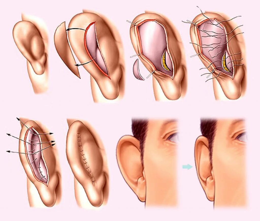 Операция убрать лопоухость. Отопластика (1 ушная раковина). Отопластика (пластика ушных раковин. Ушная раковина лопоухость.