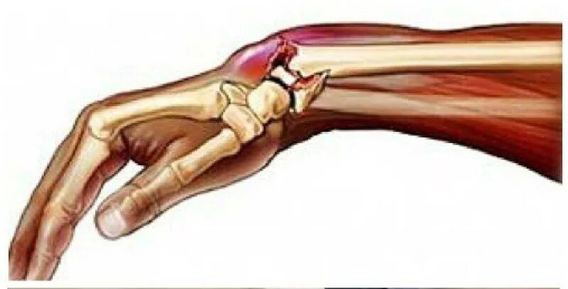 кисти когда вышла. бандаж на лучезапястный сустав при кисте. гигрома запястного сустава. кисти когда вышла. кисти когда вышла.