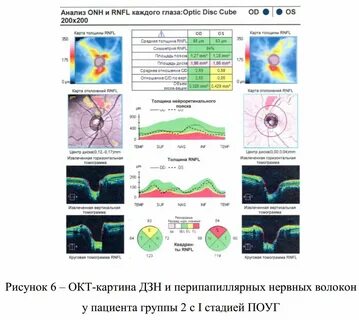Слой нервных волокон сетчатки