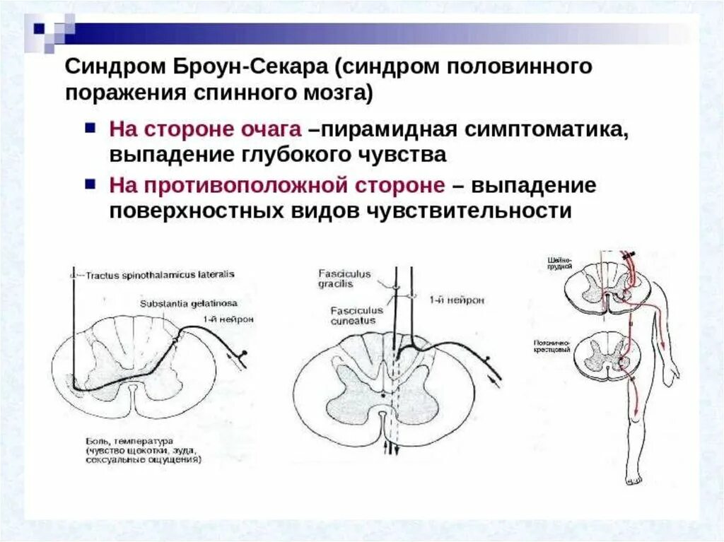 Поражение половины мозга. Очаг поражения и симптомы при синдроме Броун-Секара. Синдром половинного поражения спинного мозга Броун Секара. При синдроме Броун-Секара. Половинное поражение поперечника спинного мозга характеризуется.