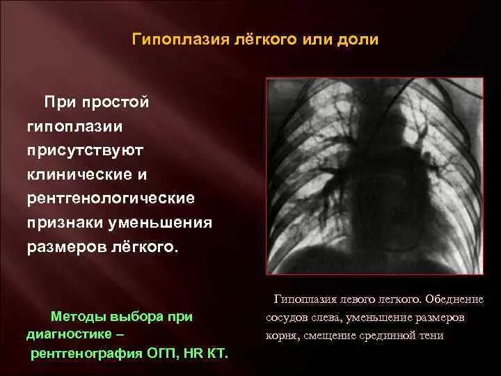 Гипоплазия доли легкого. Гипоплазия легкого рентген. Кистозная гипоплазия легкого.