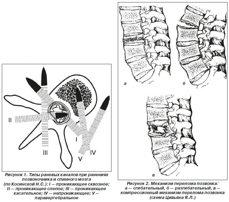 Сотрясение спинного. Боевые повреждения позвоночника и спинного мозга. Классификация огнестрельных ранений позвоночника и спинного мозга. Позвоночно спинальная травма классификация. Огнестрельное ранение спинного мозга.