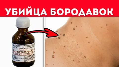 Касторовое папиллом