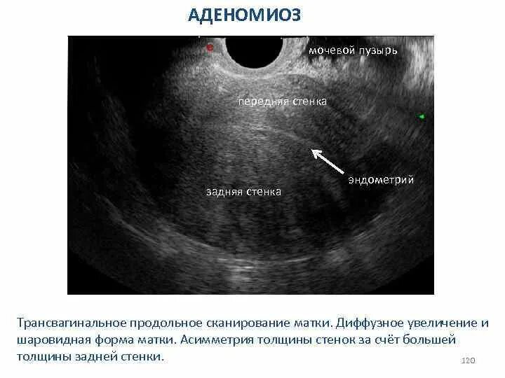 Диффузный мочевой пузырь. Узловая форма аденомиоза матки на УЗИ. Диффузный эндометриоз матки УЗИ.