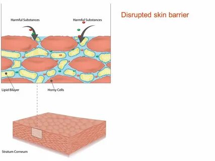 Skin barrier