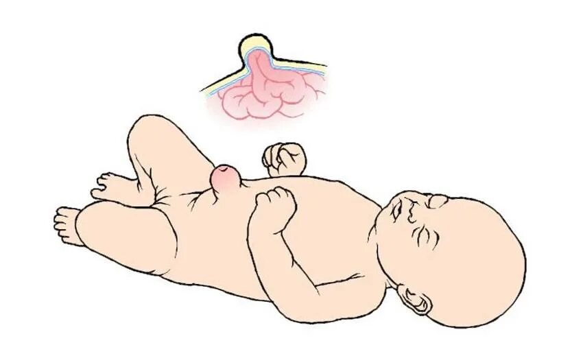 Пук новорожденных. Пупочная грыжа у новорождённых. Пупочная грыжа у грудничка. У ребёнка новорожденного грыжа пупочная грыжа. Пупочная грыжа у новорожденн.