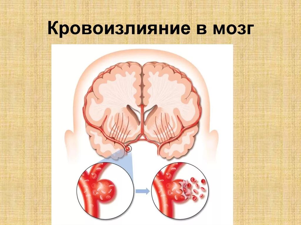 Кровоизлияние в головной мозг. Субарахноидальное кровоизлияние в мозг. Внутреннее мозговое кровоизлияние. Травматическое кровоизлияние