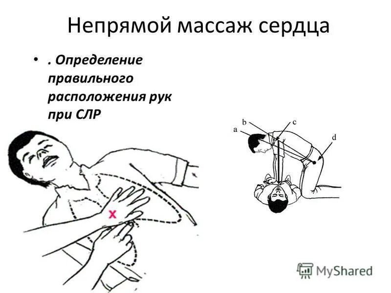 Непрямой массаж сердца это определение. Техника проведения непрямого массажа сердца алгоритм. Порядок выполнения непрямого массажа сердца кратко. Непрямой массаж сердца определение. Непрямой массаж сердца это определение.