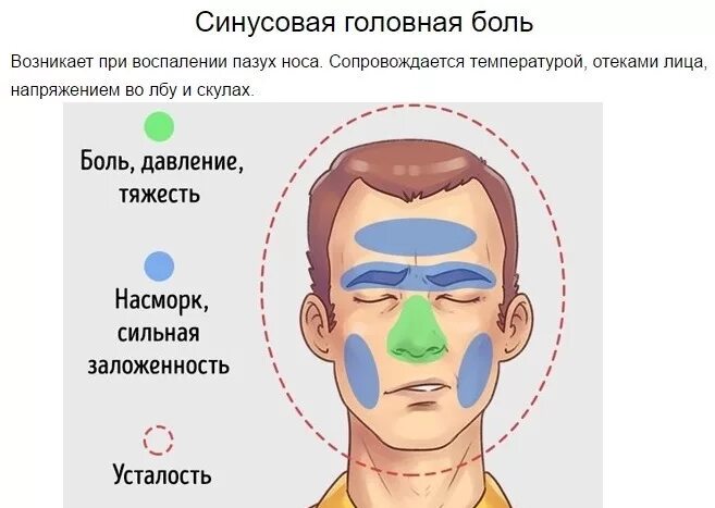 Сильно закладывает голову. Синусовая головная боль. Синусная головная боль. Синусовая боль головы. Синусная боль головы.