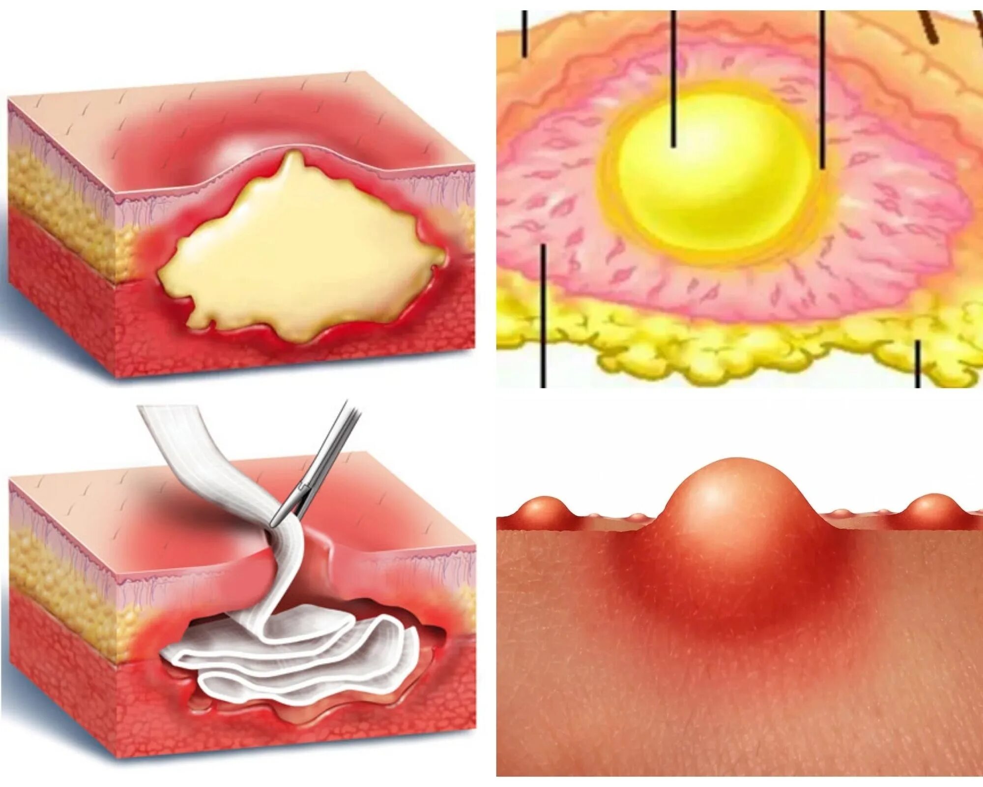 Фурункул карбункул абсцесс. Гнойный карбункул абсцесс. Постинъекционный абсцесс гной. Гнойный н