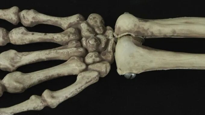 Surgeons could use these fake elastic bones to fix injuries https://