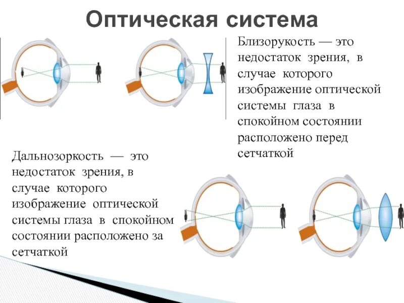 Оптическая система глаза при близорукости и дальнозоркости. Зрительный анализатор дальнозоркость и близорукость. Дальнозоркость глазное яблоко. Оптическая схема глаза с близорукостью и дальнозоркостью. Миша страдает близорукостью а его брат дальнозоркостью