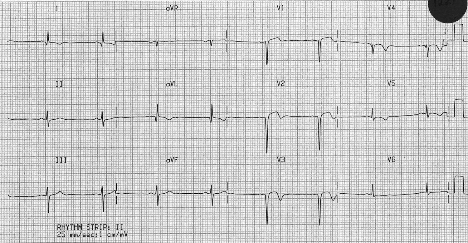 Мв на экг. ЭКГ v4 зубец t. Вольтаж комплекса QRS. Постинфарктная аневризма левого желудочка на ЭКГ. ЭКГ при аневризме левого желудочка ЭКГ.