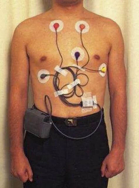 холтеровское мониторирование экг. холтеровское мониторирование экг. холтер мониторирование экг. холтеровское суточное мониторирование экг. суточное мониторирование экг и ад.