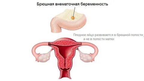 Сколько лежать после внематочной беременности