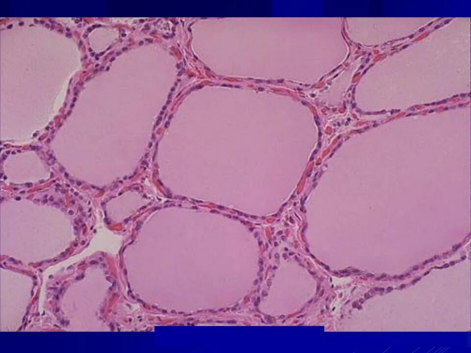 Срез щитовидной железы. Гиперфункция щитовидной железы гистология. Коллоидный зоб гистология. Щитовидная железа гистология препарат. Щитовидная железа норма микропрепарат.