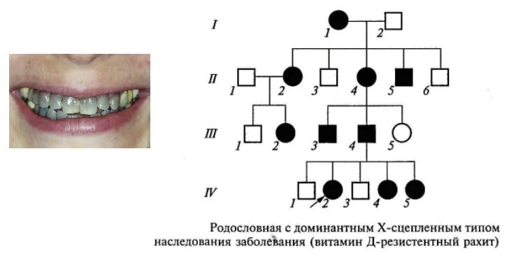 Доминантный сцепленный с х хромосомой заболевания. X сцепленный доминантный Тип наследования. Родословная с х-сцепленным доминантным типом наследования. Х сцепленный доминантный Тип наследования схема. Сцепленный с х-хромосомой доминантный Тип наследования схема.