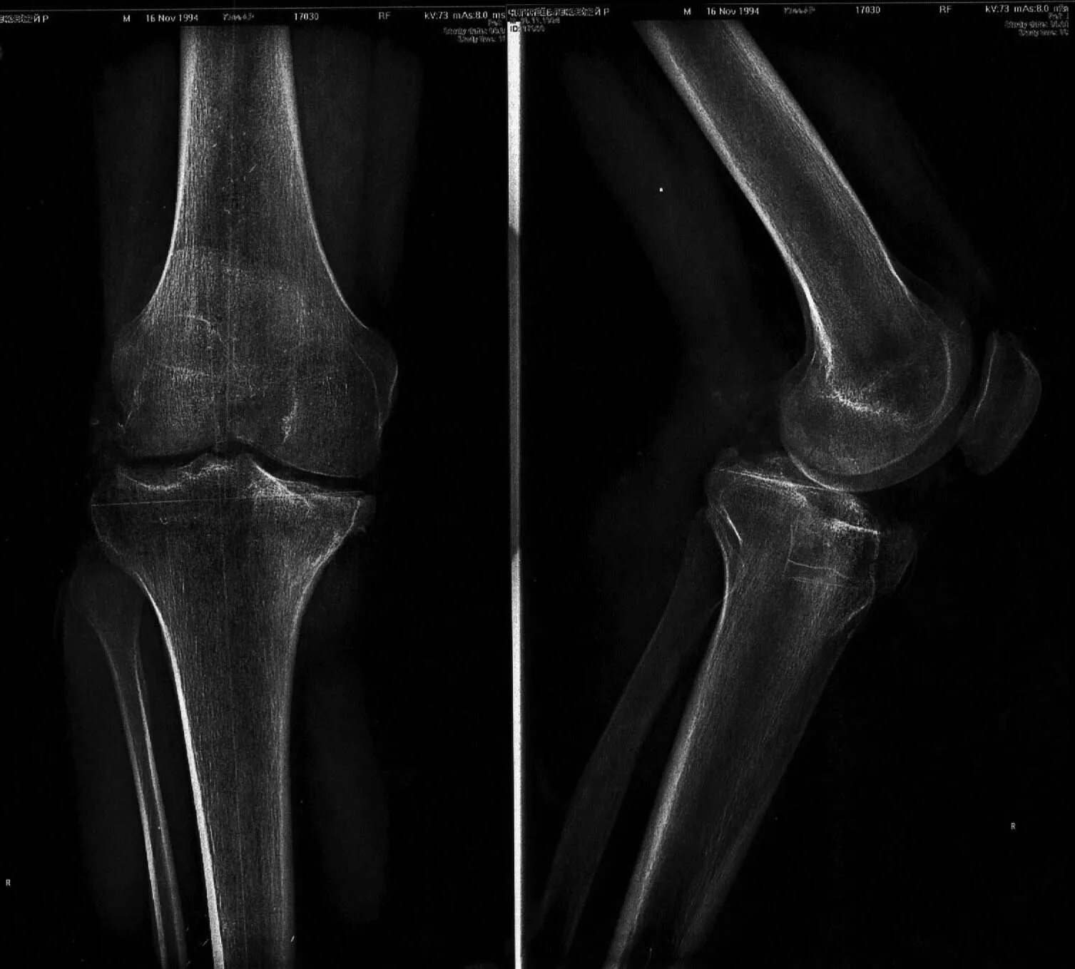 поврежден коленный сустав. тендинит четырехглавой мышцы бедра. разрыв мениска коленного сустава. поврежден коленный сустав. повреждения передней крестообразной связки (пкс).