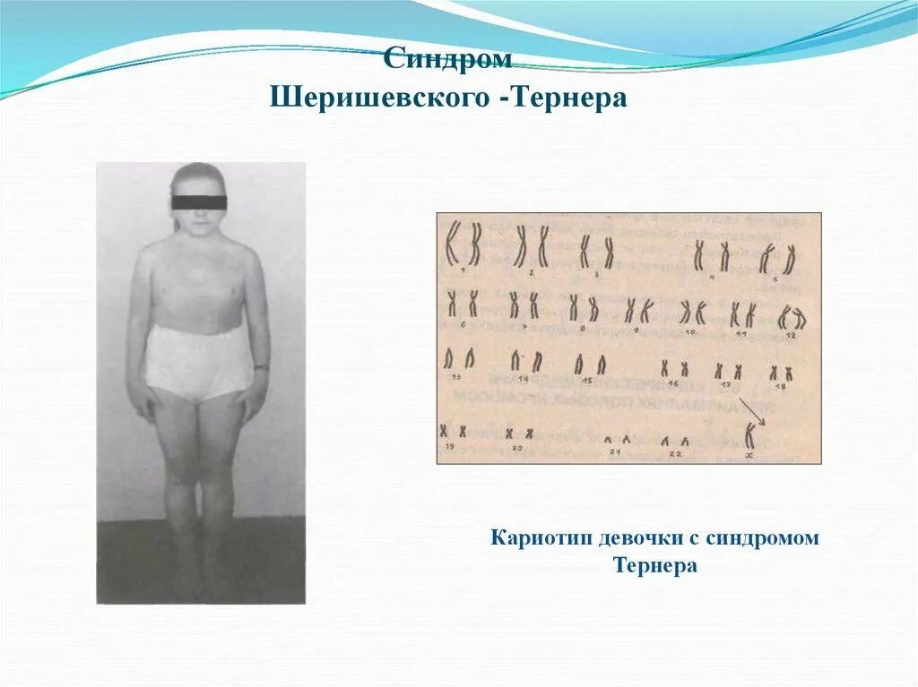 Кариотип девочки. Синдром морриса кариотип. синдром клайнфельтера люди. синдром тернера кариотип.