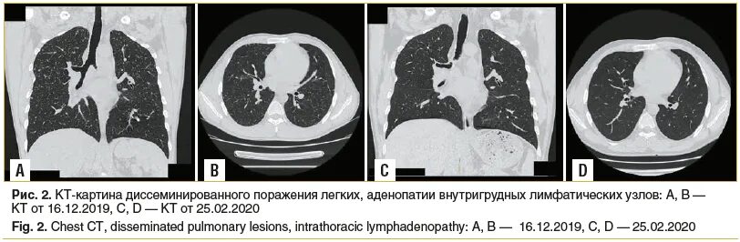 Аденопатия. Кт при саркоидозе легких. Саркоидоз кт картина.