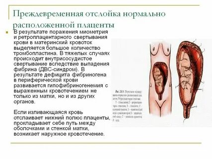 Признаки отслойки при беременности