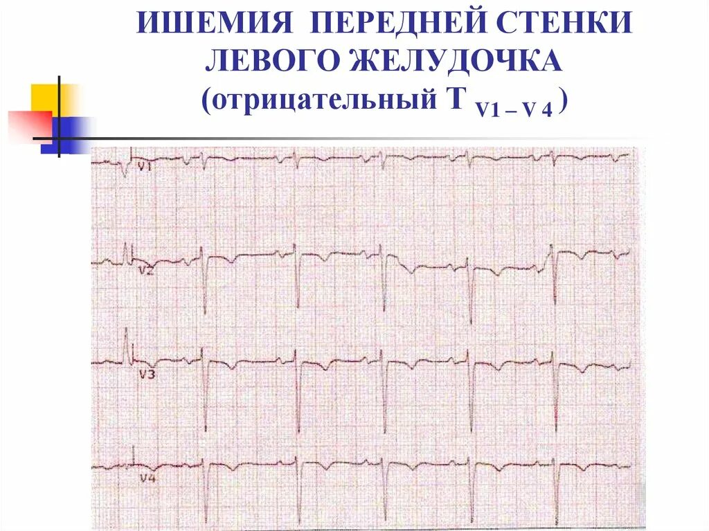 Ишемия левой стенки