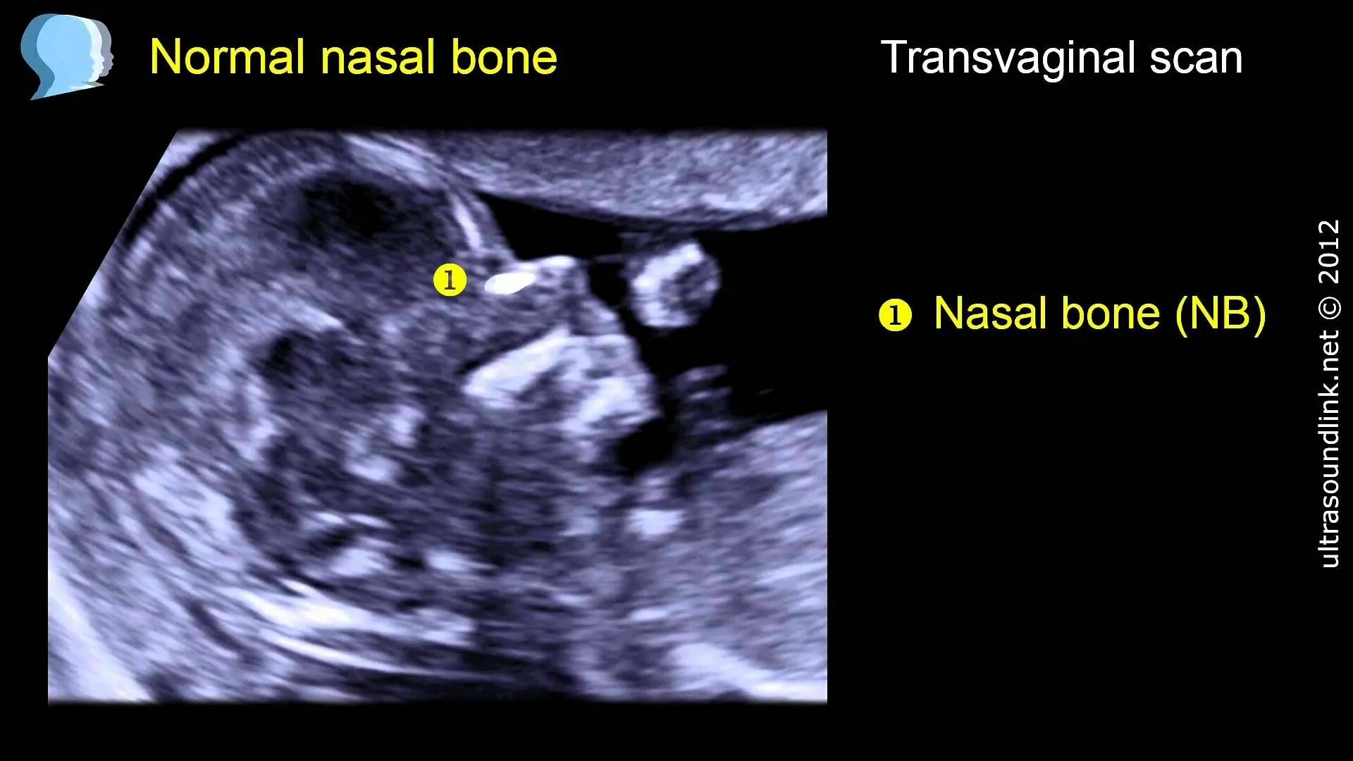 Носовая кость Дауна на УЗИ. Носовая кость с синдромом Дауна на УЗИ. УЗИ 13 недель носовая кость. УЗИ носовой кости плода на 13 неделе беременности. Кости в 13 недель