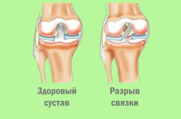 Повреждение коленной связки симптомы. Разрыв связок коленного сустава симптомы. Колено растяжение связки колена. Разрыв растяжение связок коленного сустава. Растяжение внешней боковой связки коленного сустава.