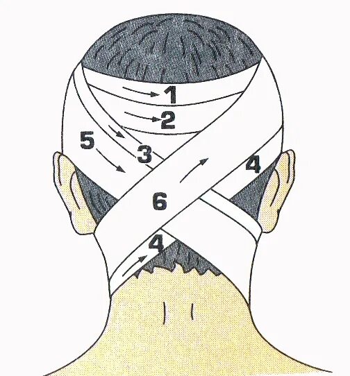 Повреждение затылка какая повязка. Крестообразная (восьмиобразная) повязка. Крестообразная ( восьмиобразная) повязка техника. Восьмиобразная повязка техника наложения. Крестообразная повязка на затылок и шею.