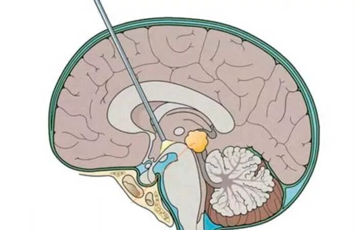 Шунт головного мозга. Шунтирование мозга гидроцефалия головного мозга. Желудочки головного мозга при гидроцефалии. Гидроцефалия эндоскопия головного мозга.