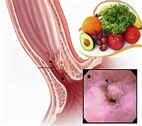 Еда стоит в пищеводе. Питание при пищеводе Барретта диета. Пищевод Барретта питание.