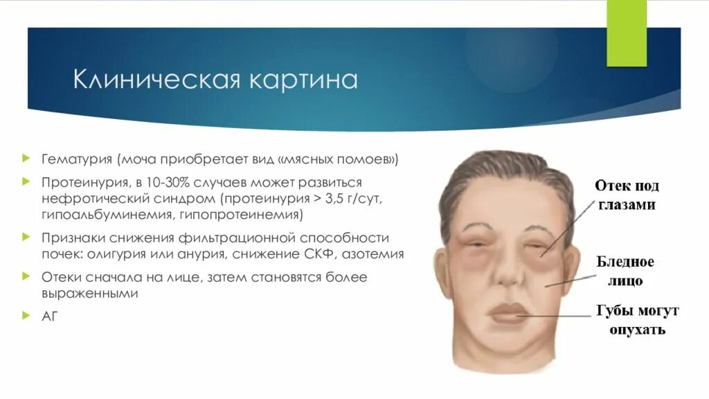 Нефротический синдром клиническая картина. Лицо при гломерулонефрите. Отеки при гломерулонефрите. Нефротический синдром отеки.