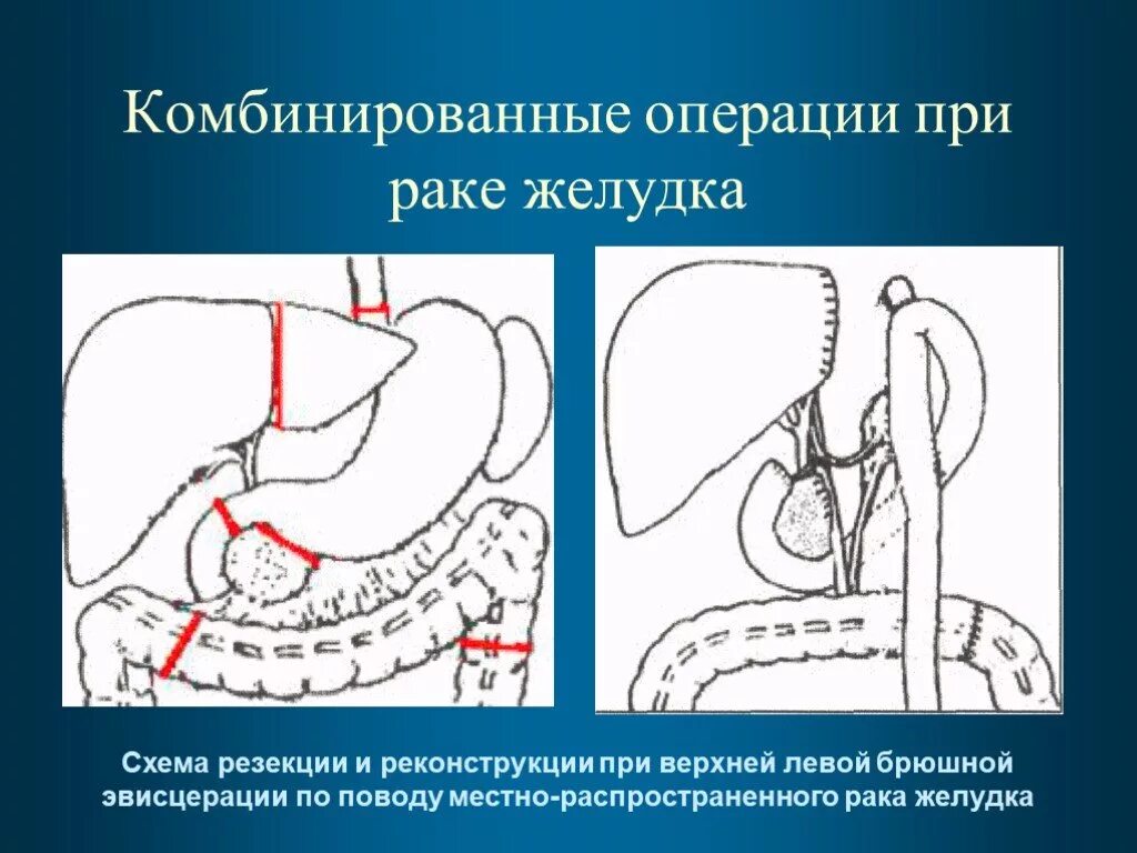 Операция гастрэктомия. Операции на желудке при опухоли. Резекция желудка при онкологии.