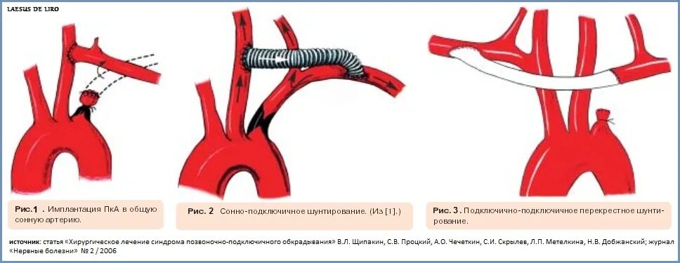 Стеноз подключичной. Синдром обкрадывания подключичной артерии. Стеноз подключичной артерии. Стеноз подключичной артерии кт. Стентирование подключичной артерии.