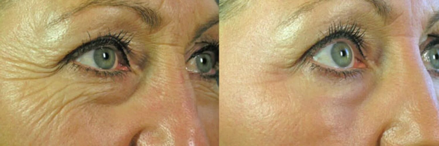 What Is the Best Age for a Facelift? 30s, 40s, 50s & Beyond - Kent V. Hasen, MD