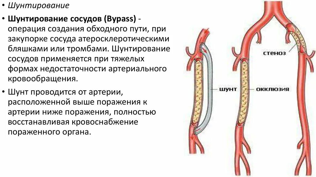 Операция на артерии нижних