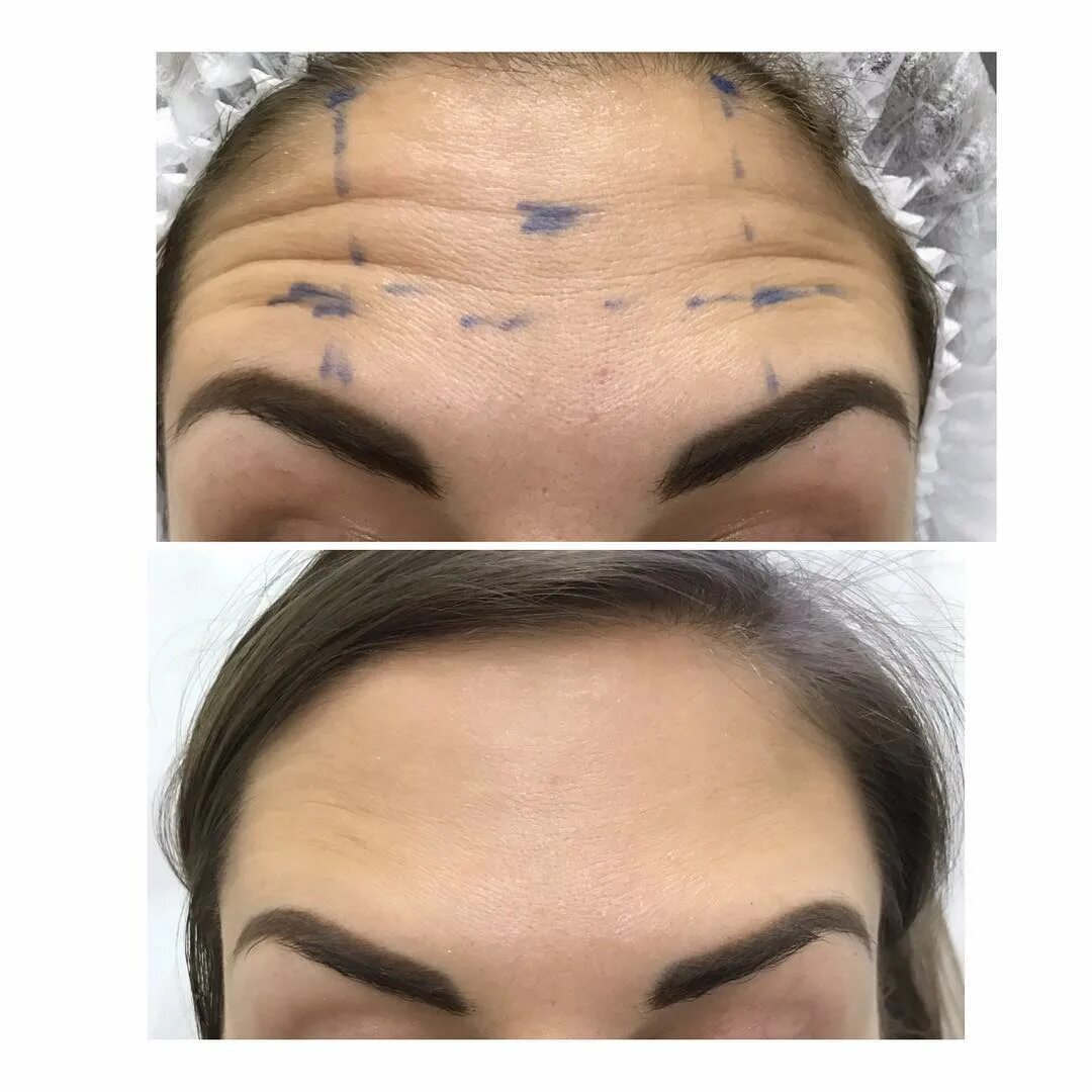 Липофилинг ростов на дону. Липофилинг ростов на дону. Липофилинг бровей. Ринопластика и подтяжка одновременно. Липофилинг нижней трети лица.