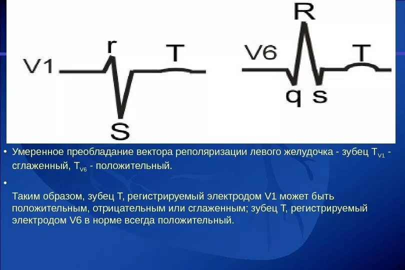 Зубец т сглаженный двухфазный. Сглаживание зубца т. Сглаженный т на ЭКГ. Сглаженность зубца т. Экг преобладание левого желудочка