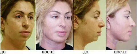 Лицо после имплантации