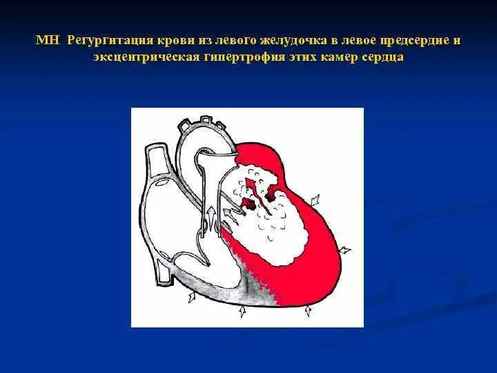Митральная регургитация. 1 степень регургитации митрального клапана. Степени регургитации митрального клапана. Недостаточность аортального клапана эхокардиография. Степени регургитации аортального клапана.