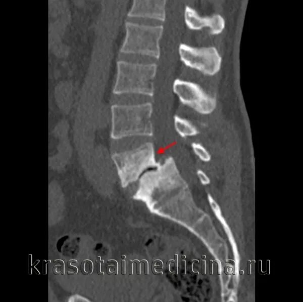 L 5 см. Спондилолистез пояснично-крестцового l5. Спондилолистез пояснично-крестцового отдела позвоночника кт. Антелистез позвонка что это l5 такое спондилолиз. Спондилолистез пояснично-крестцового отдела позвоночника l3-l4.