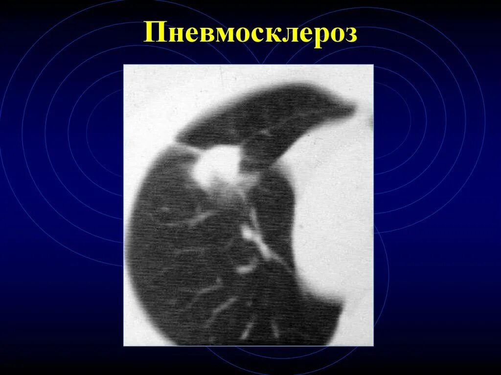 Пневмосклероз рентген. Диффузный пневмосклероз рентген. Пневмосклероз легких рентген. Диффузный пневмосклероз сколько с этим