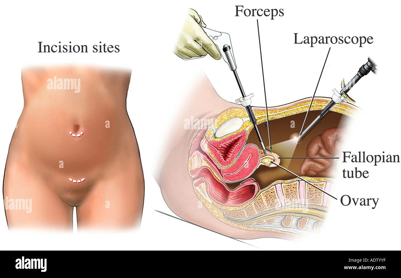 Лапароскопия кисты яичника швы. Лапароскопия эндометриоидной кисты. Киста яичника лапароскопия операции лапароскопия. Стерилизация маточных труб лапароскопия. Операции матки и трубы
