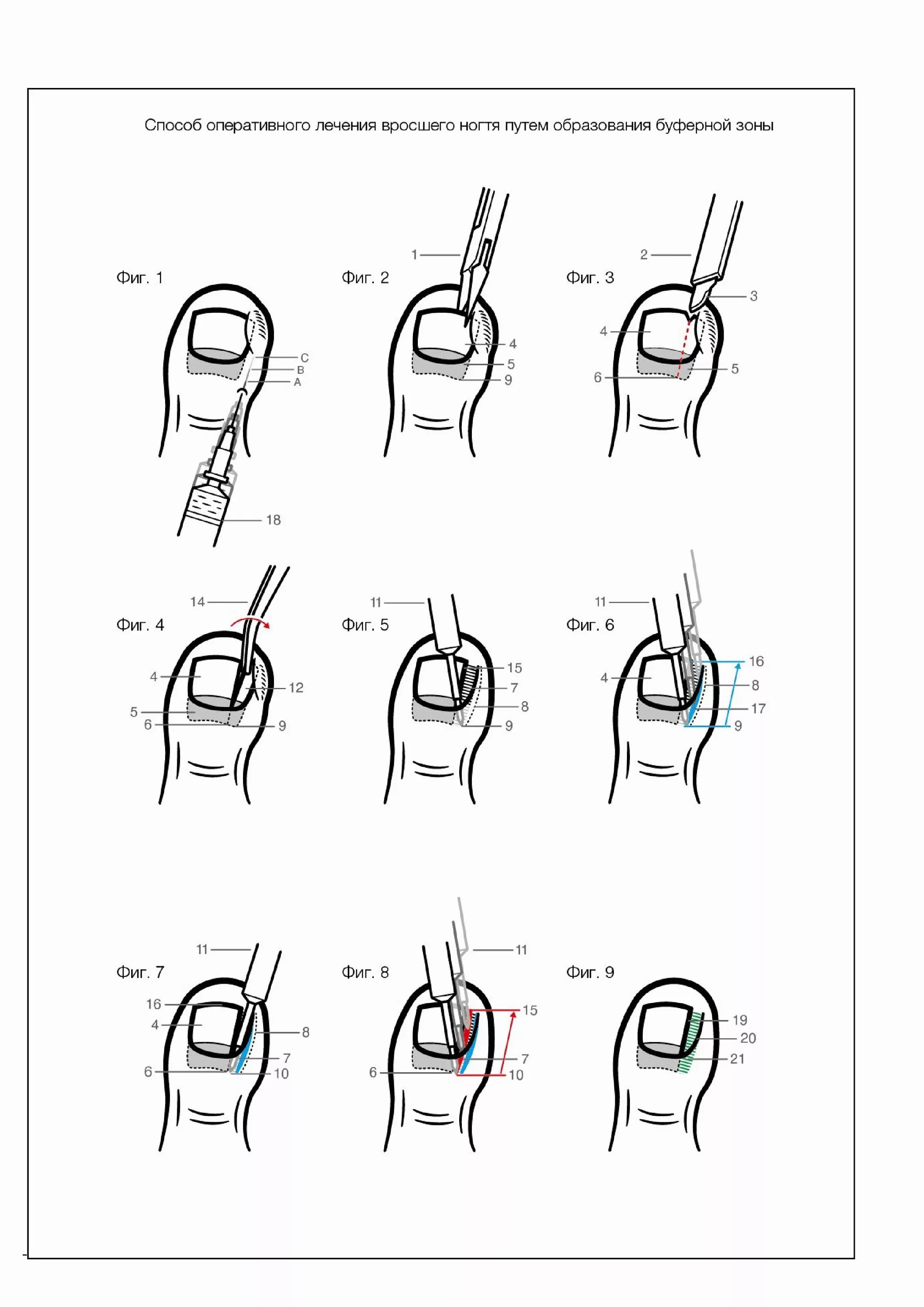 Как подстричь ноготь на пальце. Обработка вросшего ногтя схема. Вросший ноготь оперируют схема. Вросший ноготь схема врастания.
