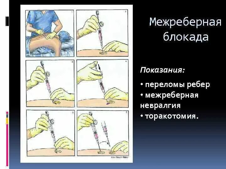 Блокада показания. Межреберная новокаиновая блокада показания техника. Новокаиновые блокады перелом ребер. Межреберная невралгия блокады. Блокада нерва при межреберной невралгии.