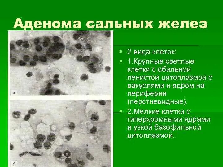 Аденома сальной железы цитология. Клетки с крупными гиперхромными ядрами. Доброкачественная гиперплазия сальных желез. Аденома сальных желез гистология. Клетки с гиперхромными ядрами