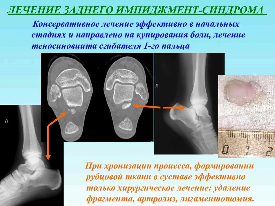 Синдром голеностопных суставов