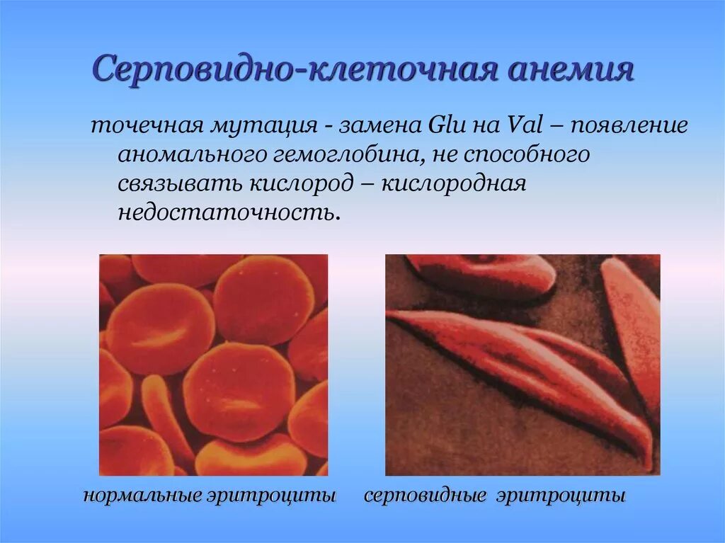 Эритроциты при серповидноклеточной анемии. Серповидноклеточная анемия генная мутация. Серповидная анемия генное заболевание. Серповидная клеточная анемия гемоглобин. Серповидно клеточная анемия признаки